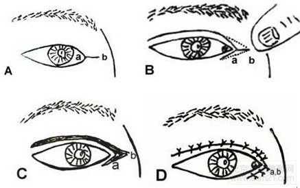 Speath法内眦开大术