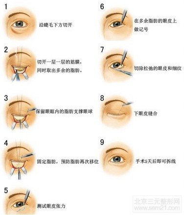 外切法去眼袋手术示意图