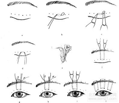 额部悬吊矫正上睑下垂 手术示意图
