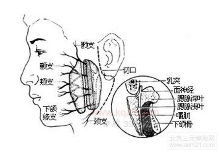 耳后切口下颌角切除术手术示意图