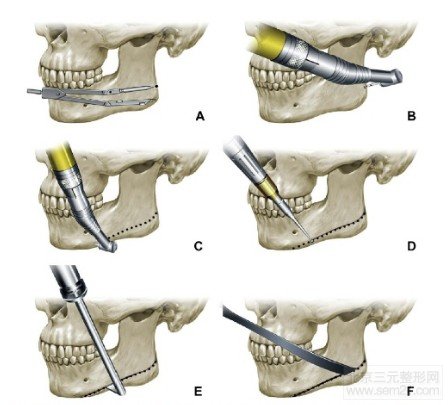 下颌角切除示意图