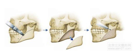 下颌角切除术手术示意图