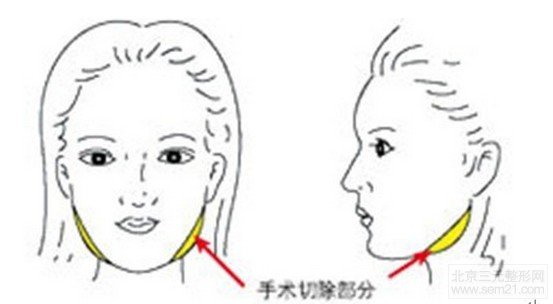 咬肌肥大切除手术示意图