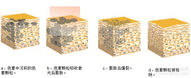 E光治疗太田痣解说图