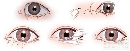 Z成形法内眦开大术 手术示意图