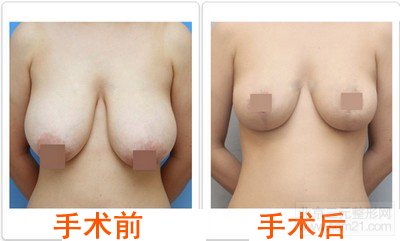 悬吊法矫正乳房下垂术前术后对比图