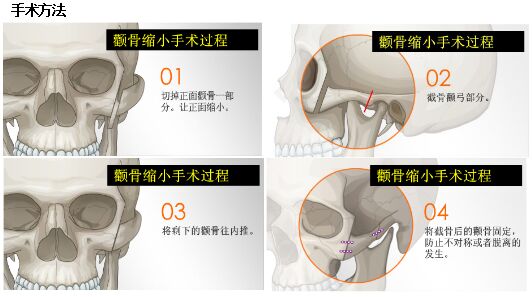 磨颧骨整形手术方法