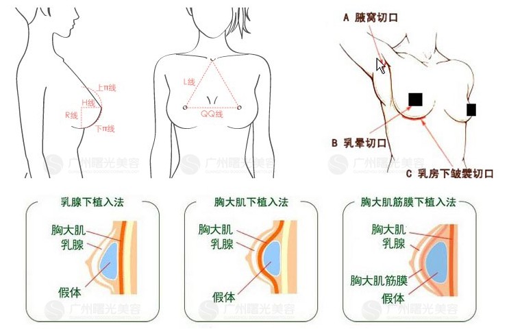 假体隆胸切口的选择