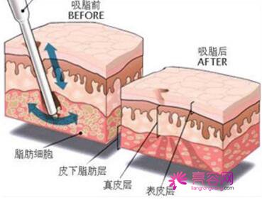 南京美莱,吸脂,怎么样,价格,案例