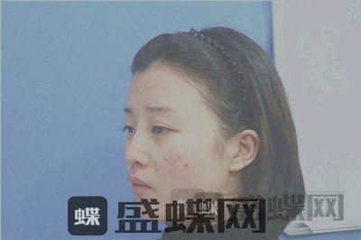 杭州格莱美，张龙，鼻部手术，案例，价格，