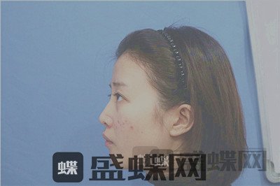 杭州格莱美，张龙，鼻部手术，案例，价格，