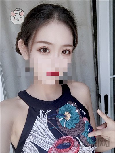 杭州美莱，韩超，双眼皮，案例，价格，