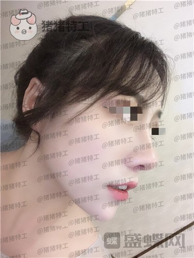 云南华美美莱，洪晓娅，鼻部手术，案例，价格，