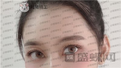 武汉美基元，，双眼皮，案例，价格，