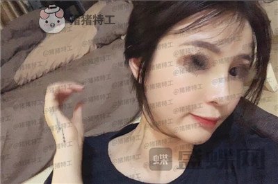 洛阳华美宋俊岭隆鼻案例价格