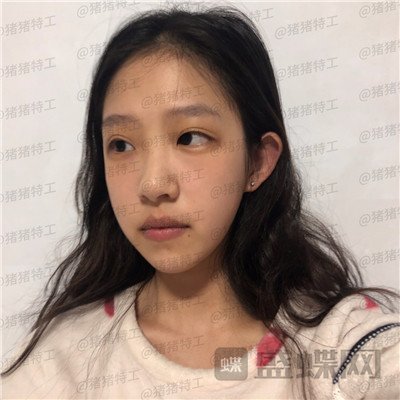 杭州美莱，韩超，鼻部手术，案例，价格，