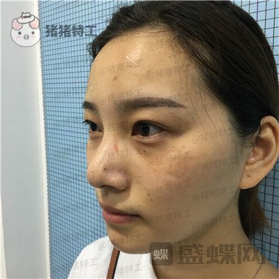 杭州格莱美，王馨婉，双眼皮，案例，价格，