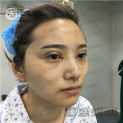 杭州格莱美，王馨婉，双眼皮，案例，价格，