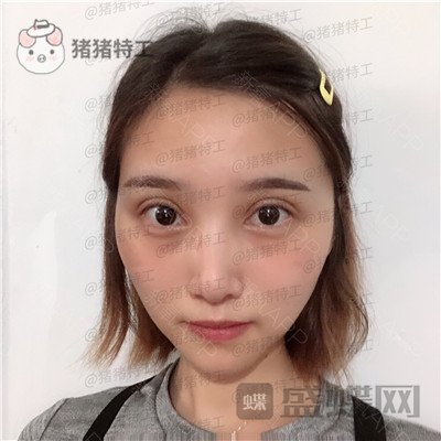 杭州格莱美，王馨婉，双眼皮，案例，价格，